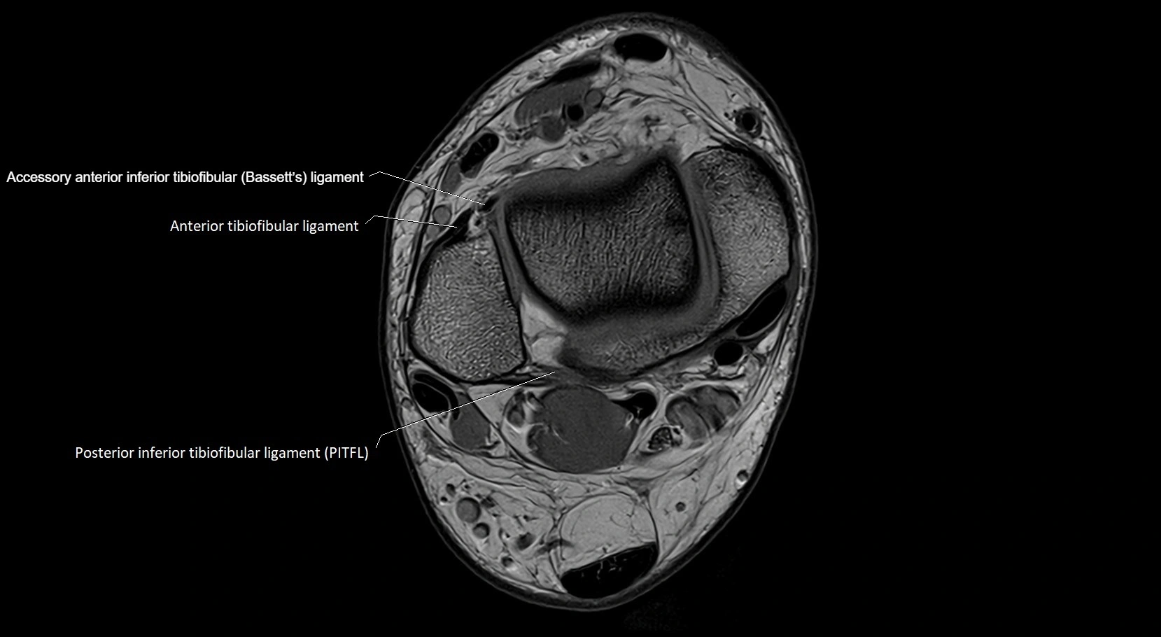 MRI ankle ligaments anatomy axial 3T image 4.webp